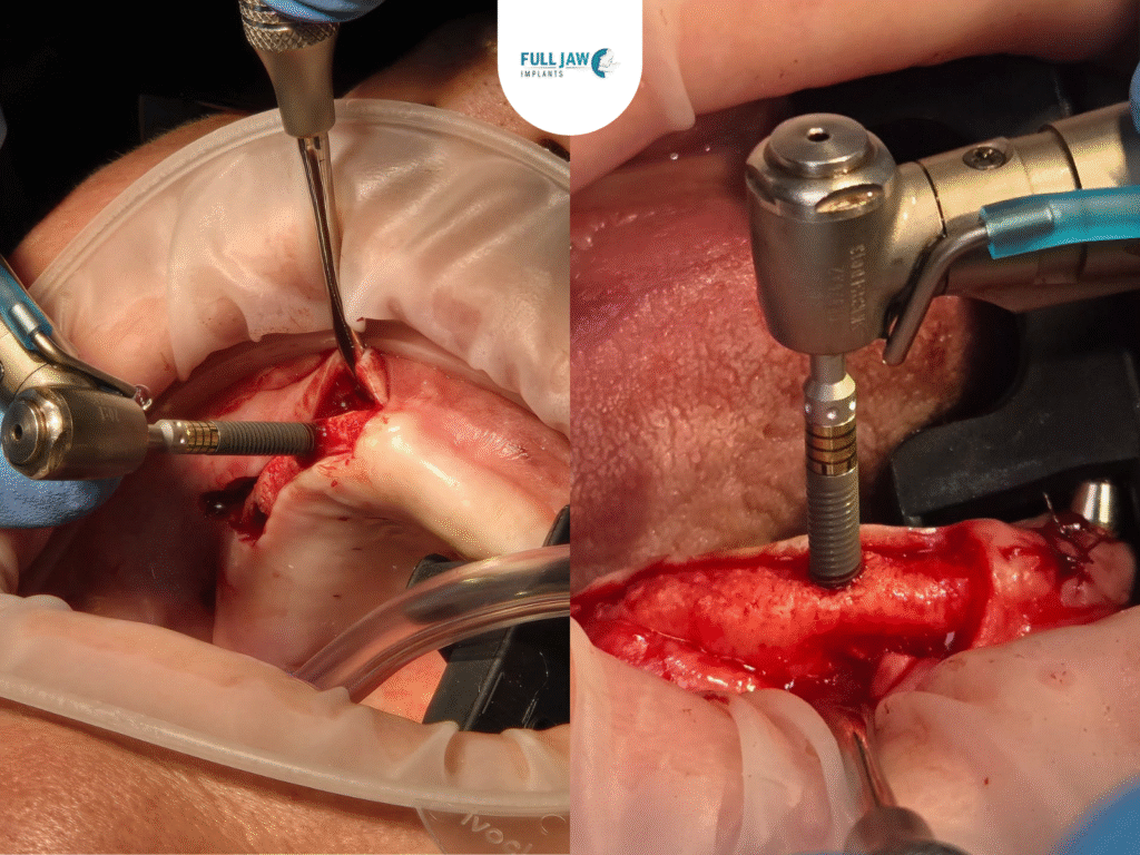 dental implant surgery dr samy kafagy