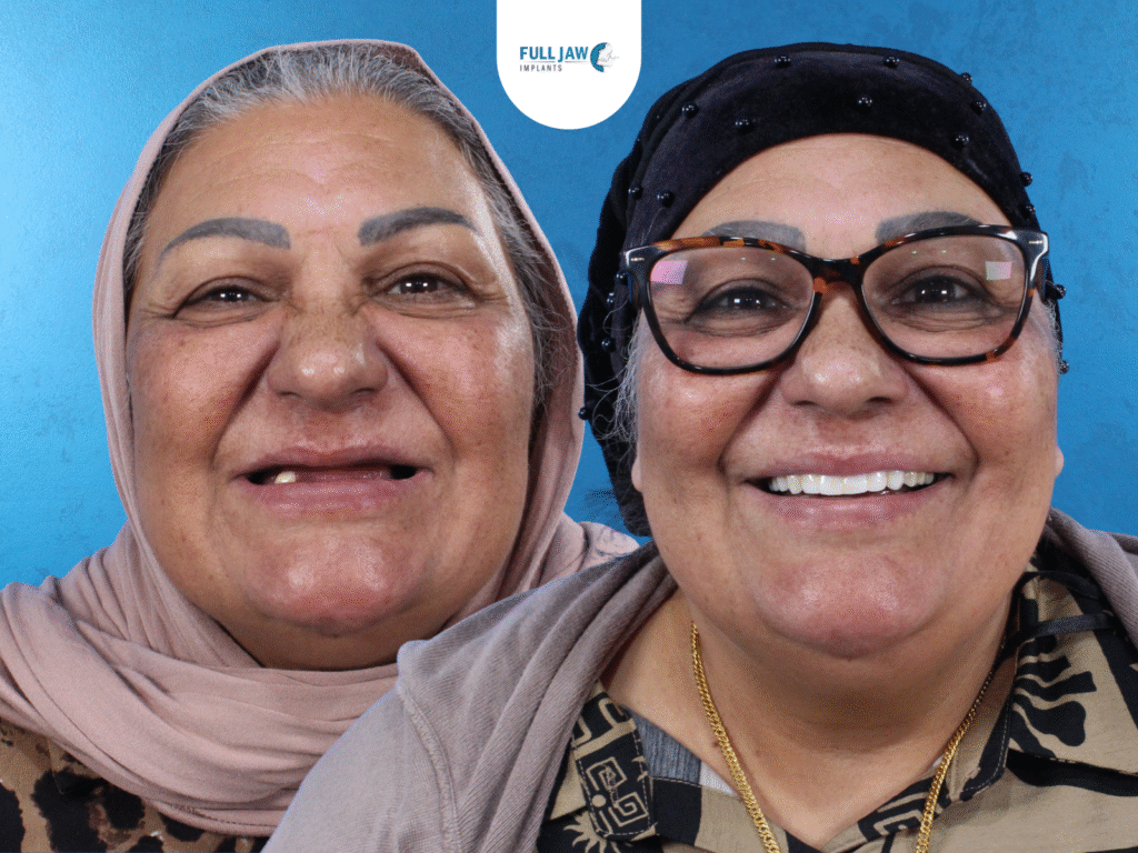 all-on-4 implants before and after
