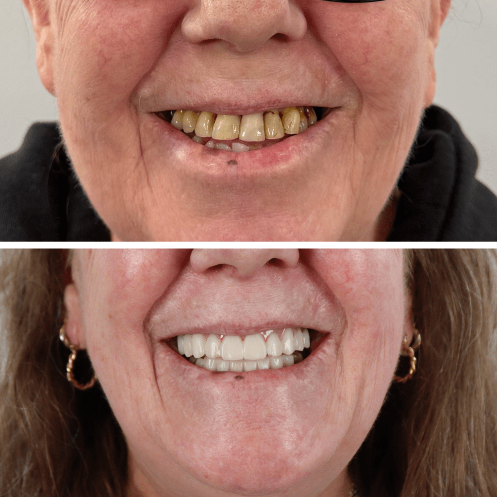 dental imlants before and after
