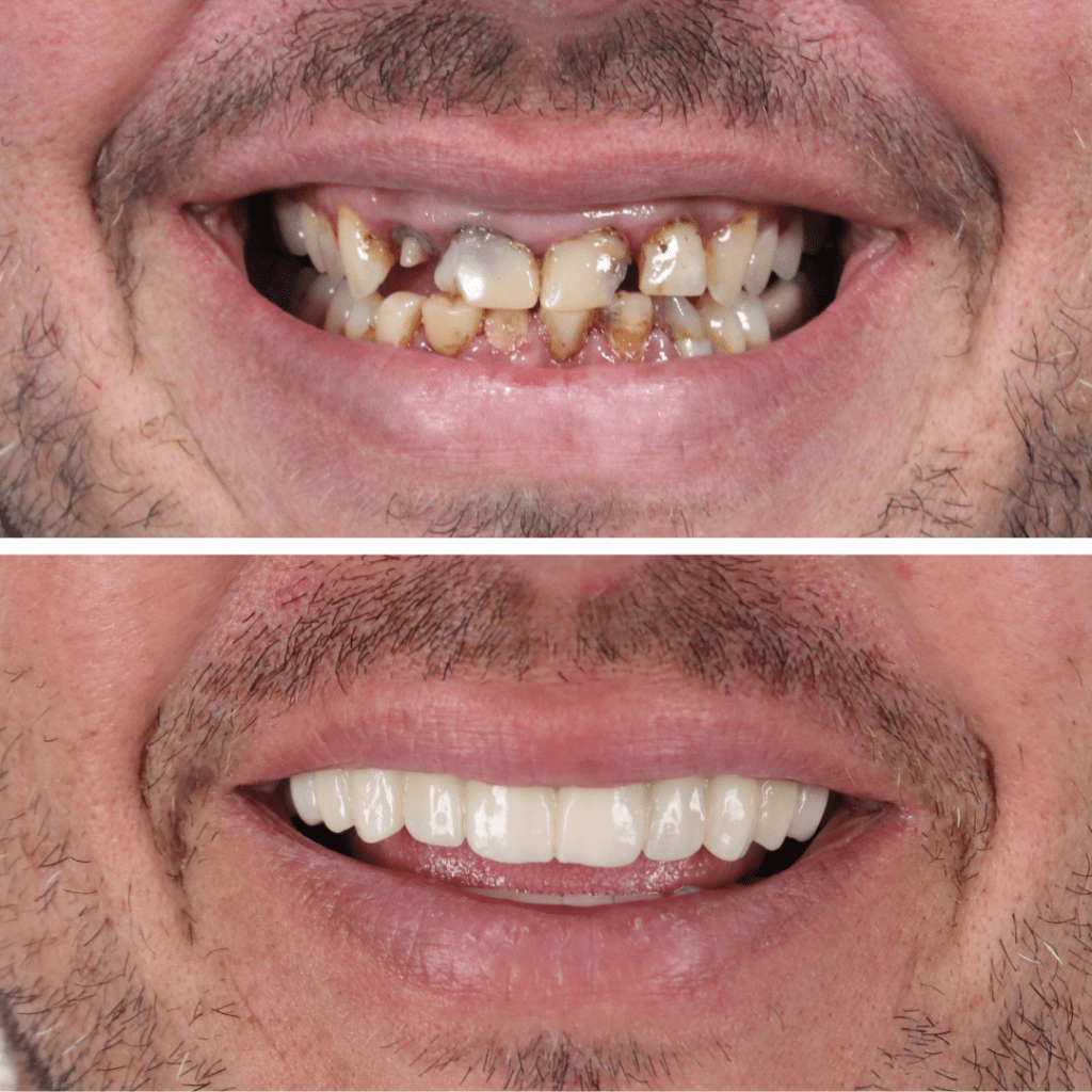 dental imlants before and after