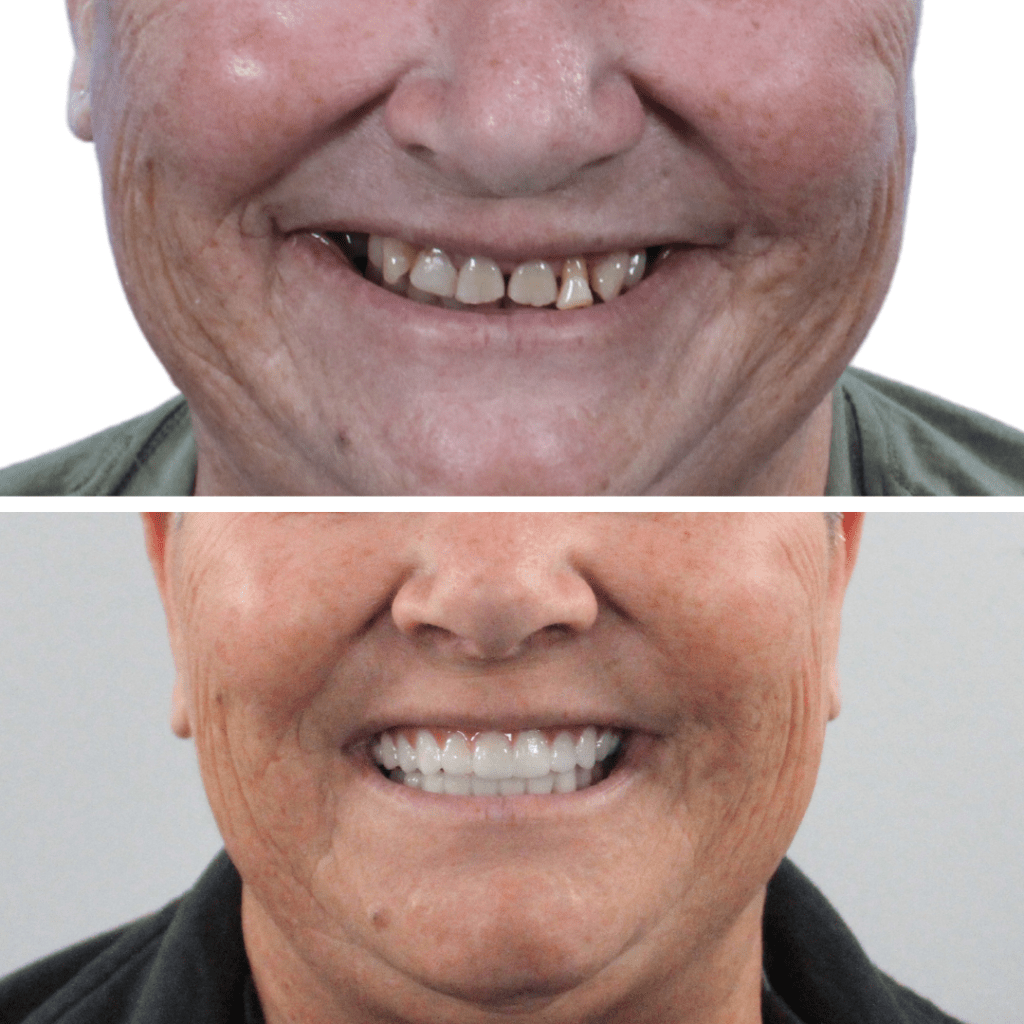 dental imlants before and after