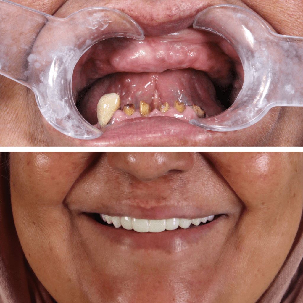 dental imlants before and after