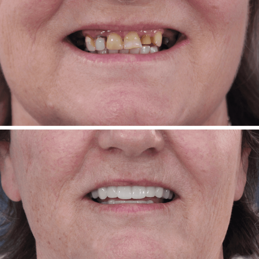 dental imlants before and after