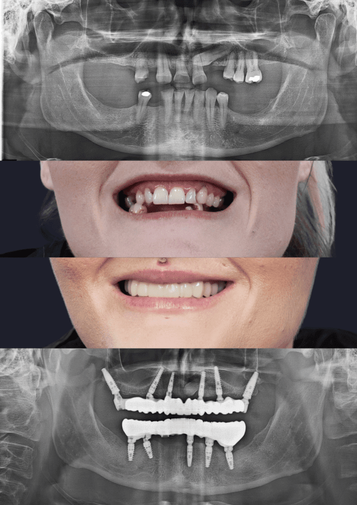 Before and after dental implants adelaide
