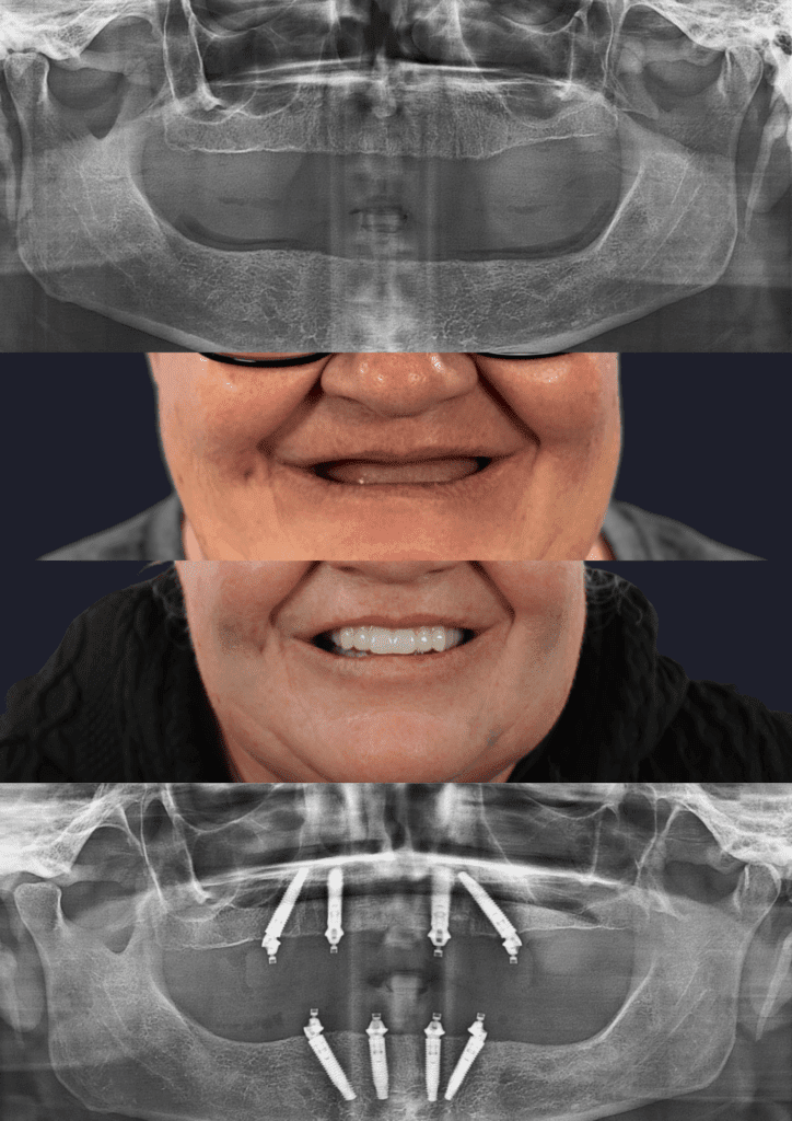 Before and after dental implants adelaide