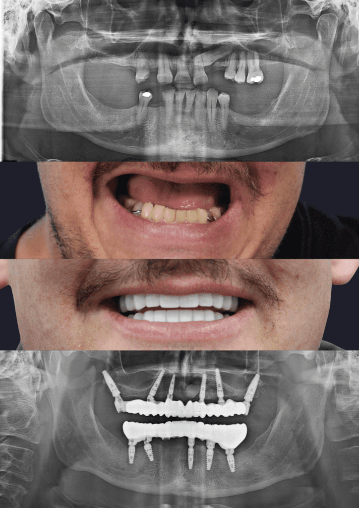 Before and after dental implants adelaide