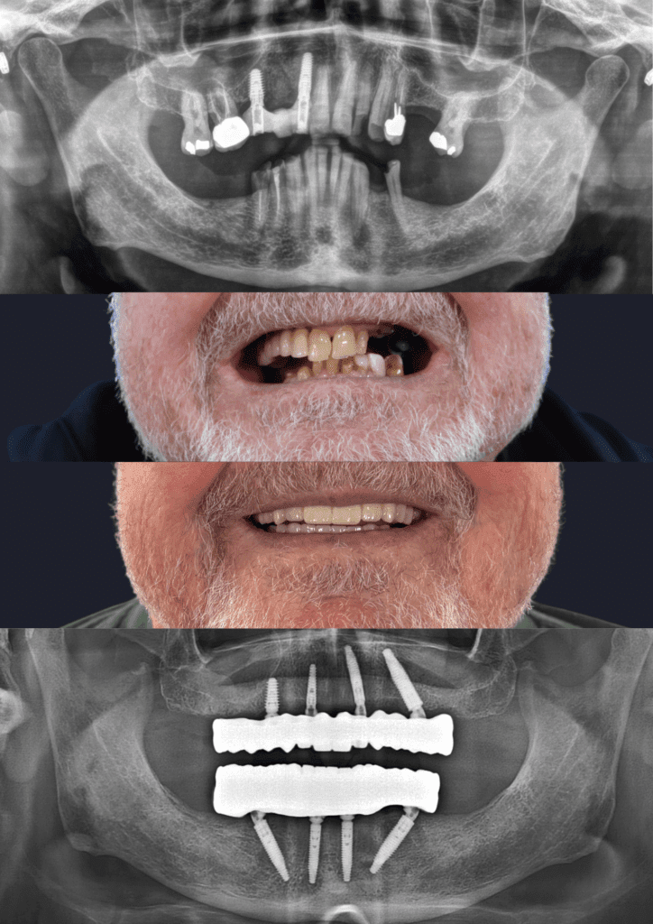Before and after dental implants adelaide