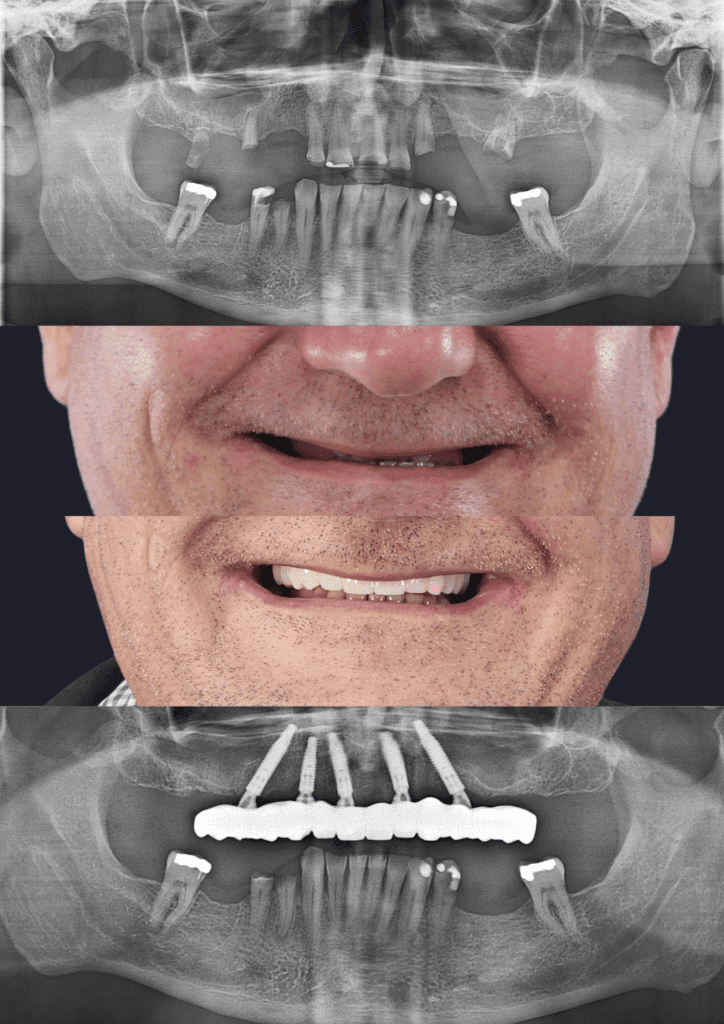 Before and after dental implants adelaide