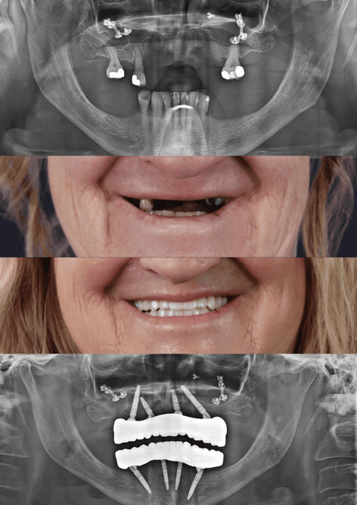 Before and after dental implants adelaide