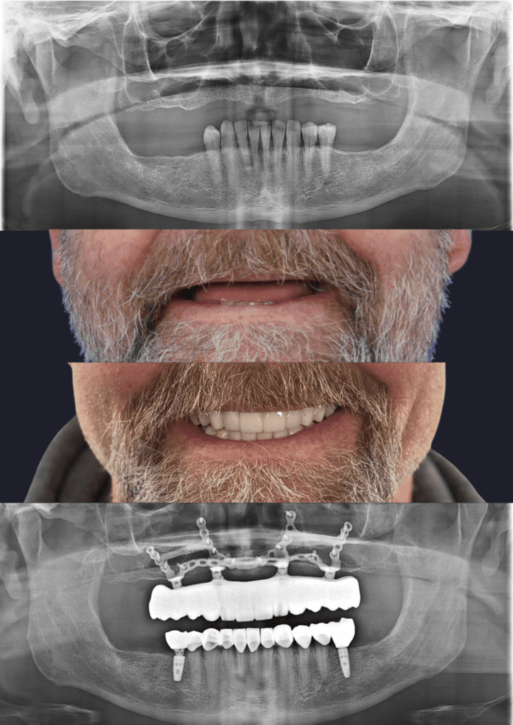 Before and after dental implants adelaide