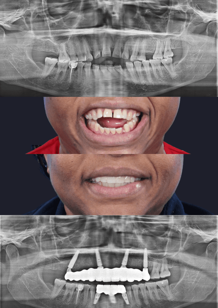 Before and after dental implants adelaide