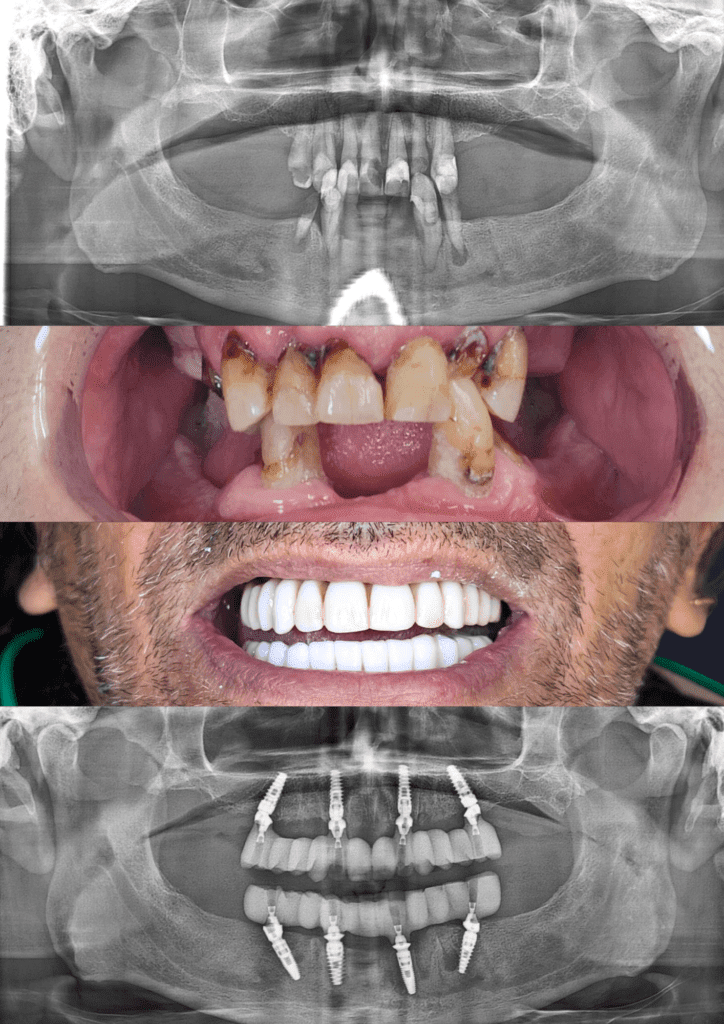 Before and after dental implants adelaide