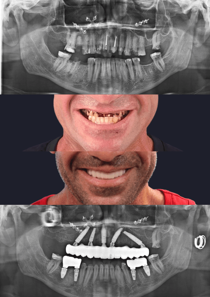 Before and after dental implants adelaide