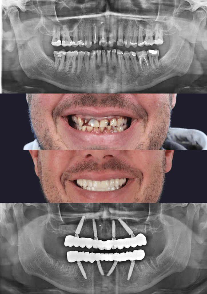 dental implants adelaide