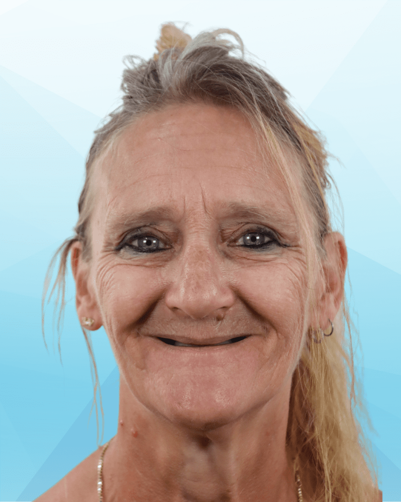 Dental Implants After