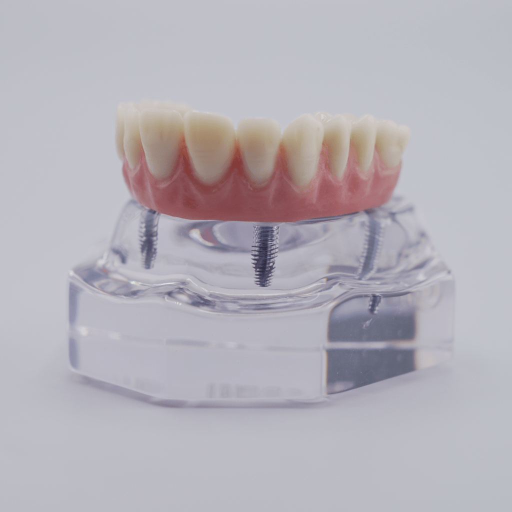 all-on-4 dental implant model of upper arch prothesis